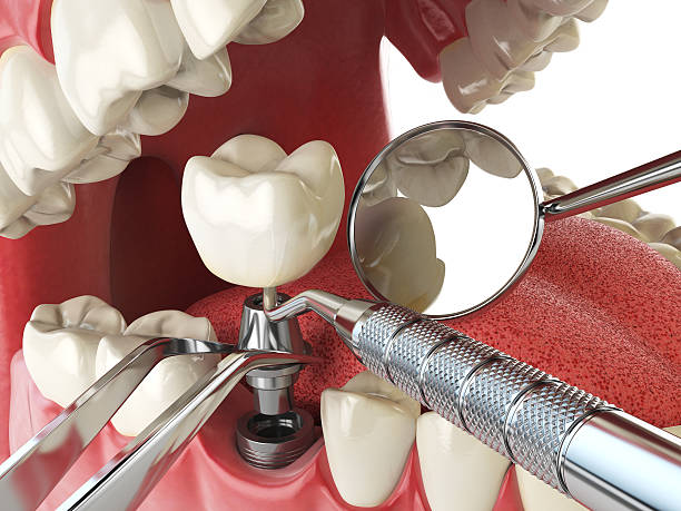 Best Emergency Wisdom Tooth Extraction in Cocoa Beach, FL